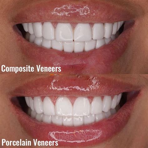 resin veneers vs porcelain.